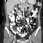 CT Abdomen coronar