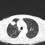 CT Thorax axial (Lungenfenster)