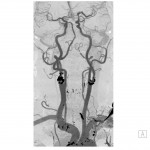 CT-Angiographie Karotis