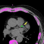 CT CaScoring