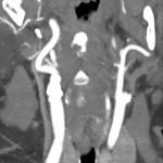 CT-Angiographie Karotis MIP