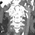 CT-Angiographie Karotis MIP