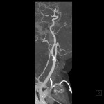 CT-Angiographie Karotis MIP