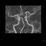 CT-Angiographie Circulus Willisi