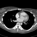 CT Thorax axial