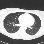 CT Thorax axial