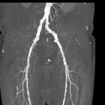 CT-Angiographie Becken