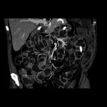 CT Enteroklysma