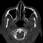 CT der Nasennebenhöhlen