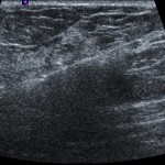 Ultraschall geleitete Brustbiopsie