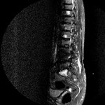 MR Lendenwirbelsäule sagittal