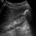Ultraschall Niere re.