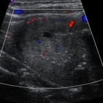 Sonogramm Schilddrüse