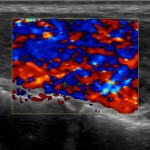 Sonogramm Schilddrüse