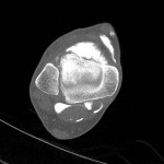 CT Arthrographie