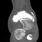 CT Arthrographie