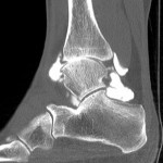 CT Arthrographie