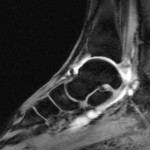 MR Arthrographie sag.