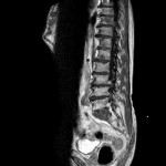 MR Lendenwirbelsäule sagittal