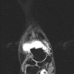 MR Arthrographie cor.