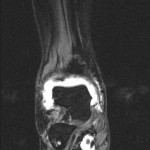 MR Arthrographie cor.